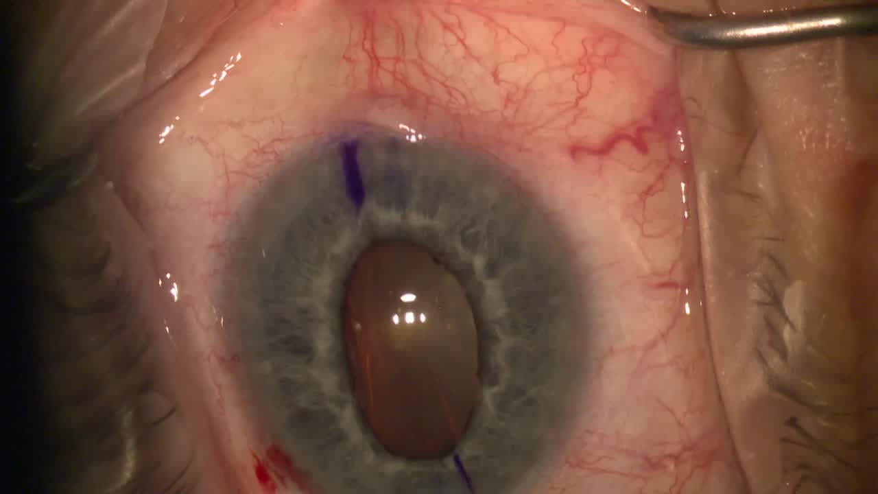 Are Pupil Expanders Necessary? 