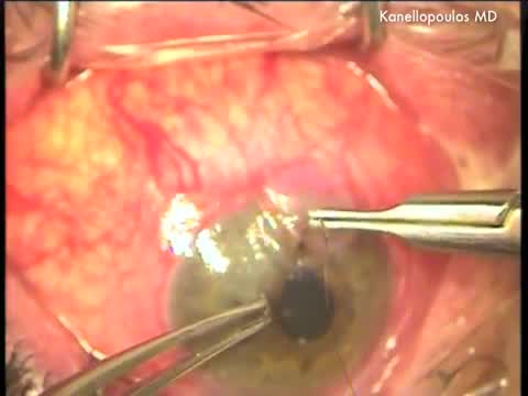 Corneal Patch Graft for Rheumatic Perforation