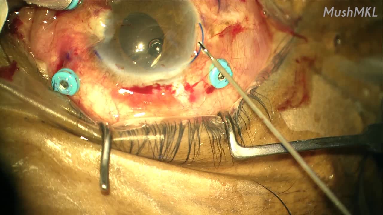 Scleral-Fixated IOL Yamane Technique