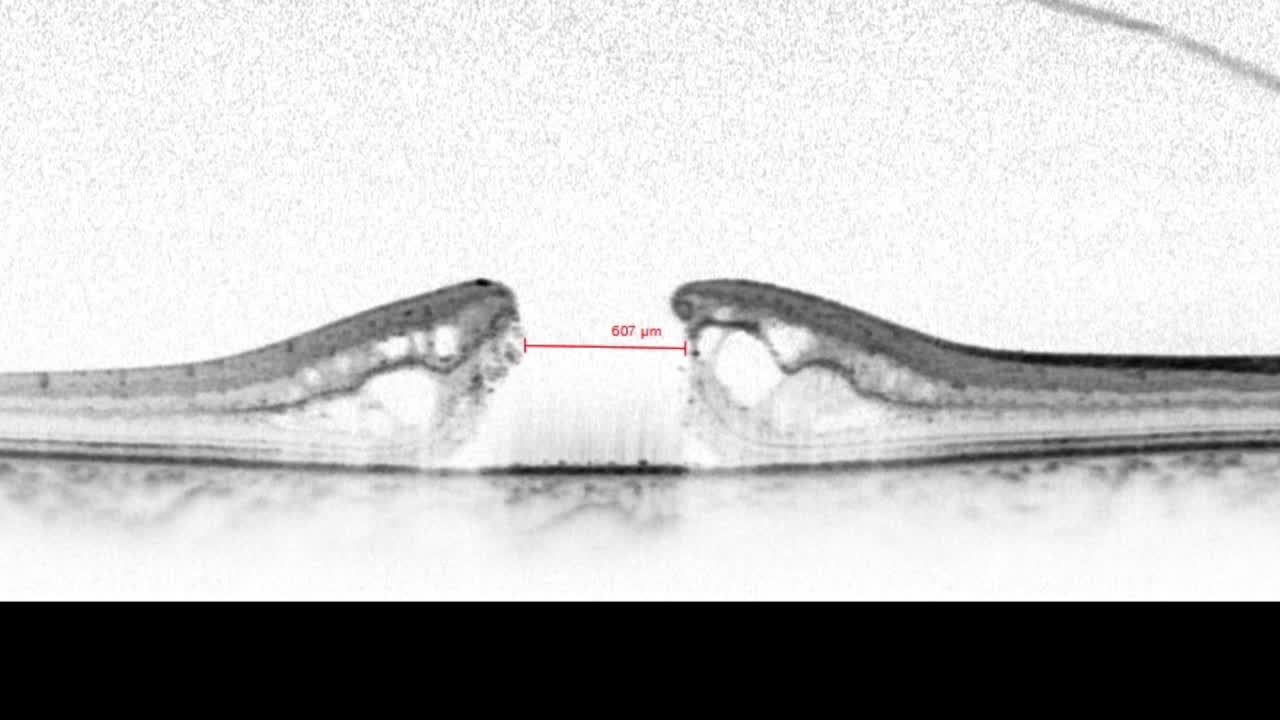 Inverted ILM Flap for Large Macular Holes