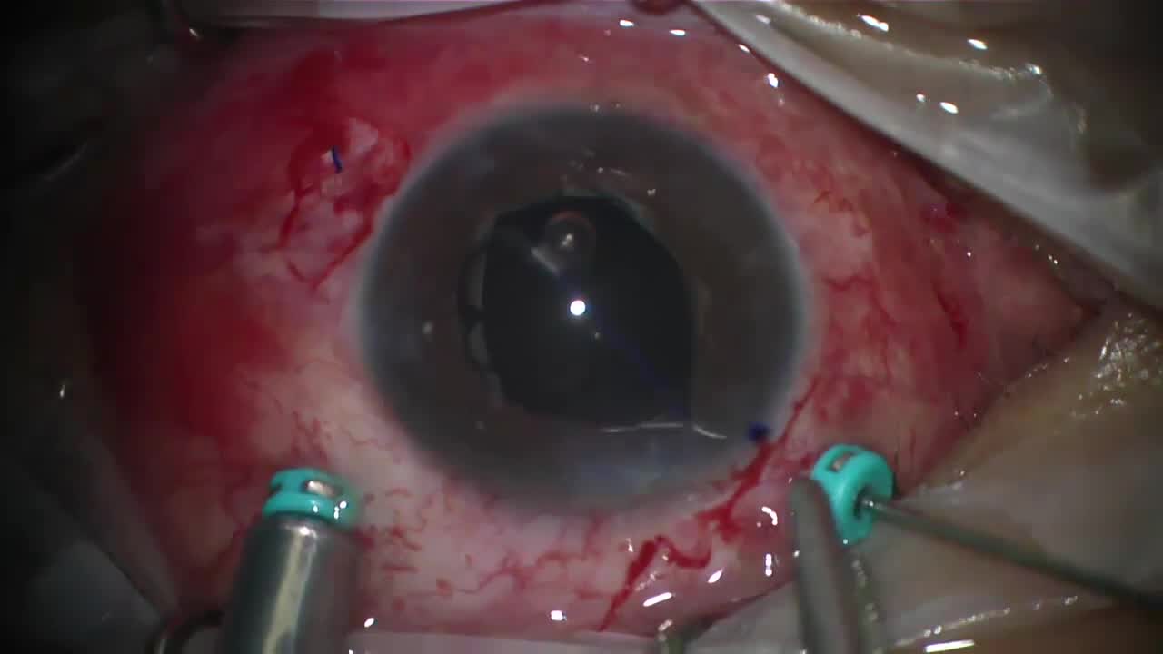 Secondary Three-Piece IOL Fixation 