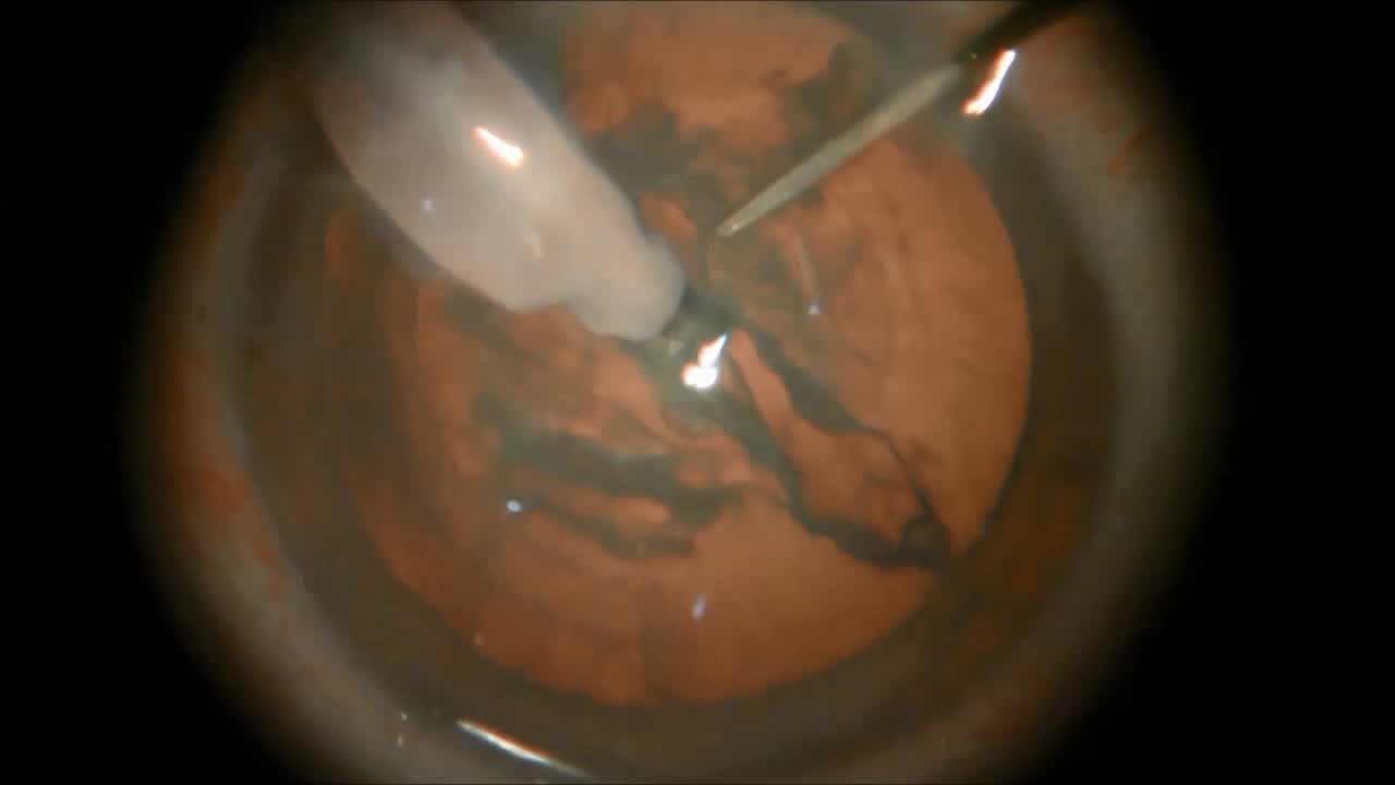 Routine Cataract Surgery With a PanOptix Trifocal IOL