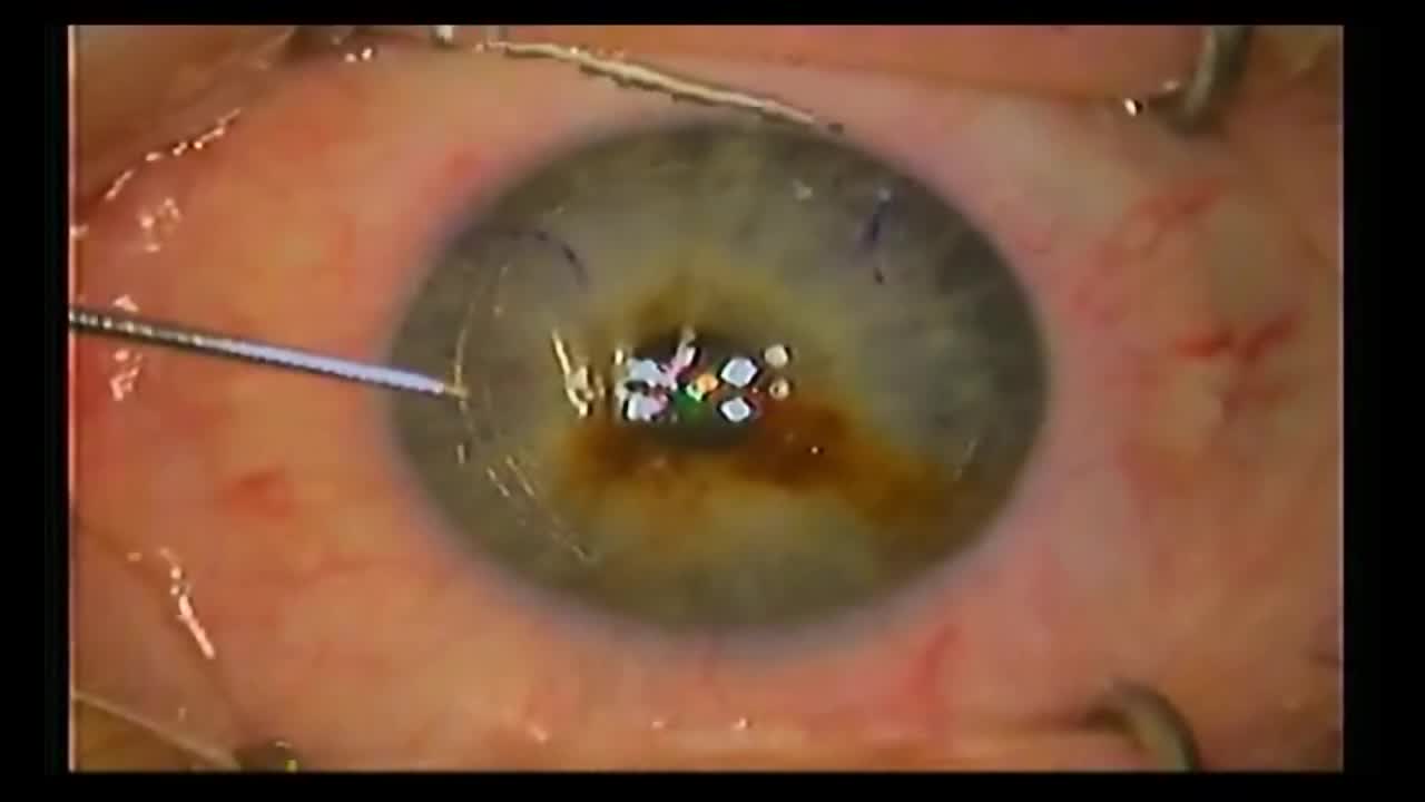 Combined LASIK and KAMRA Insertion Using the Alcon FS200