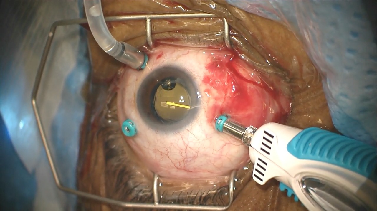 Iluvien Injection at the Time of Vitrectomy