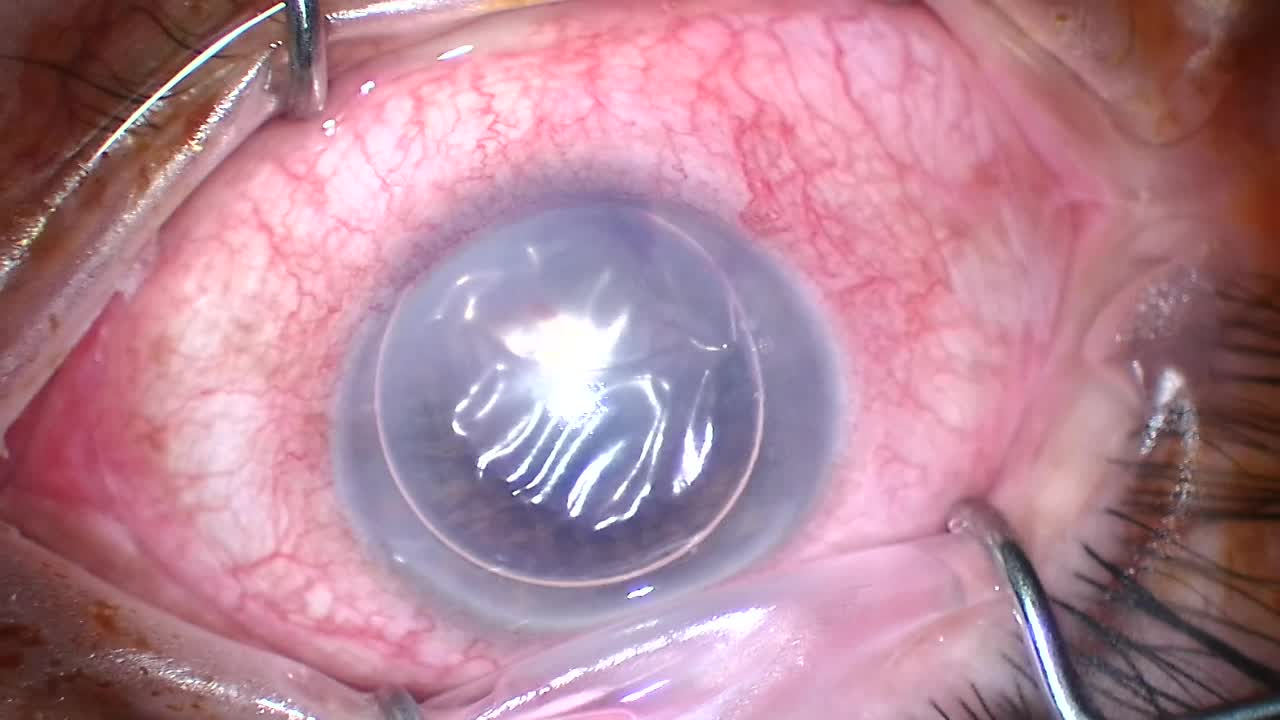 Descemet's Membrane Detachment 