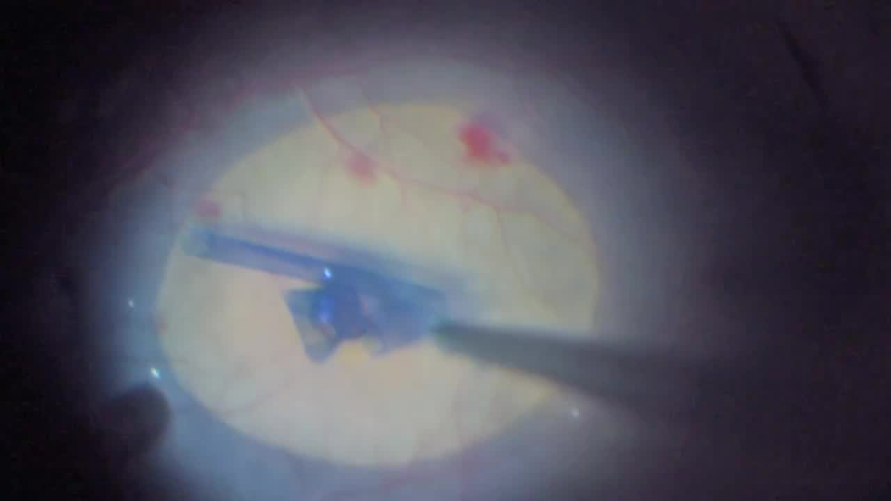 ILM Folding Technique for Large Macular Holes 