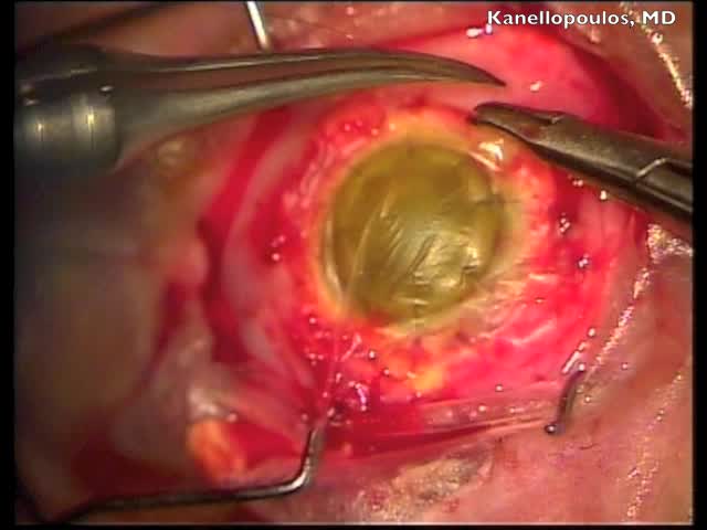 Lamellar Corneal Patch Graft Pretreated With Cross Linking 
