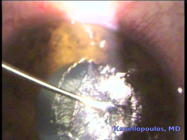 Surgical Management of Epithelial Ingrowth From Corneal Trauma