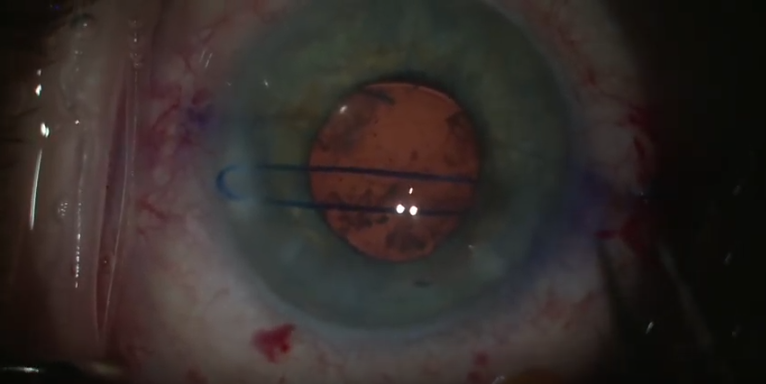 Belt Loop Scleral Fixation With 5-0 Prolene Sutures