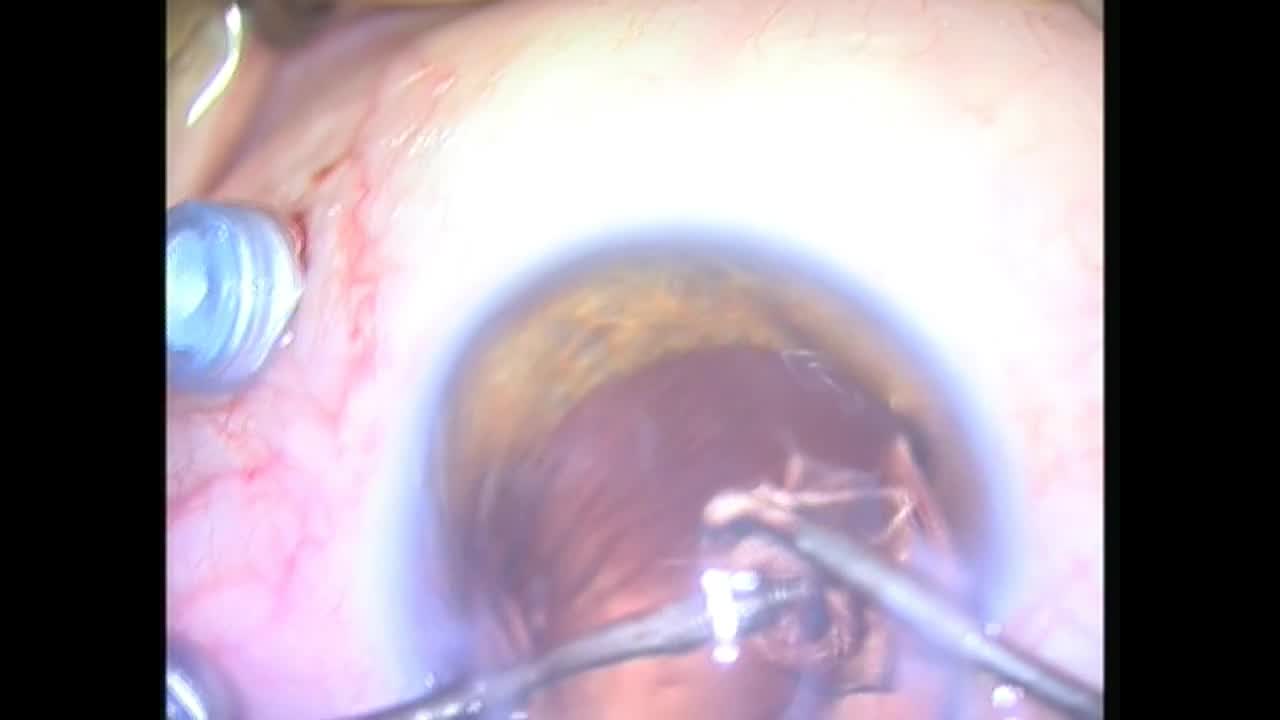 The Retinal Glide: A New Technique