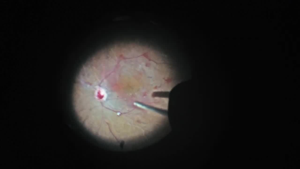 Vitrectomy for Severe Diabetic Retinopathy and Vitreous Hemorrhage