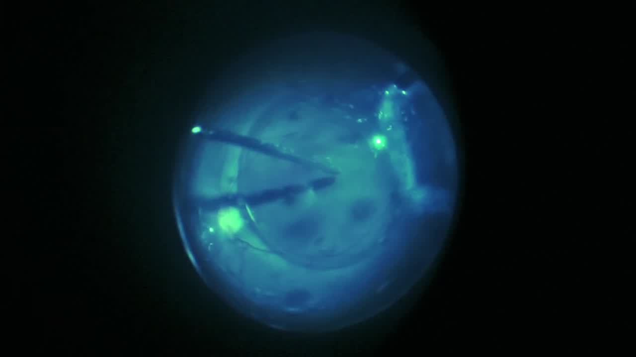 Buckle Vitrectomy for Macular-On Retinal Detachment and PVR