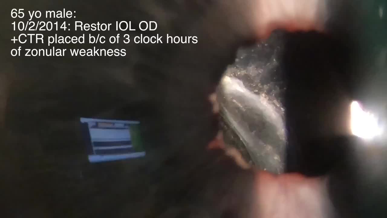 Scleral Suture-Fixation of a ReSTOR IOL 