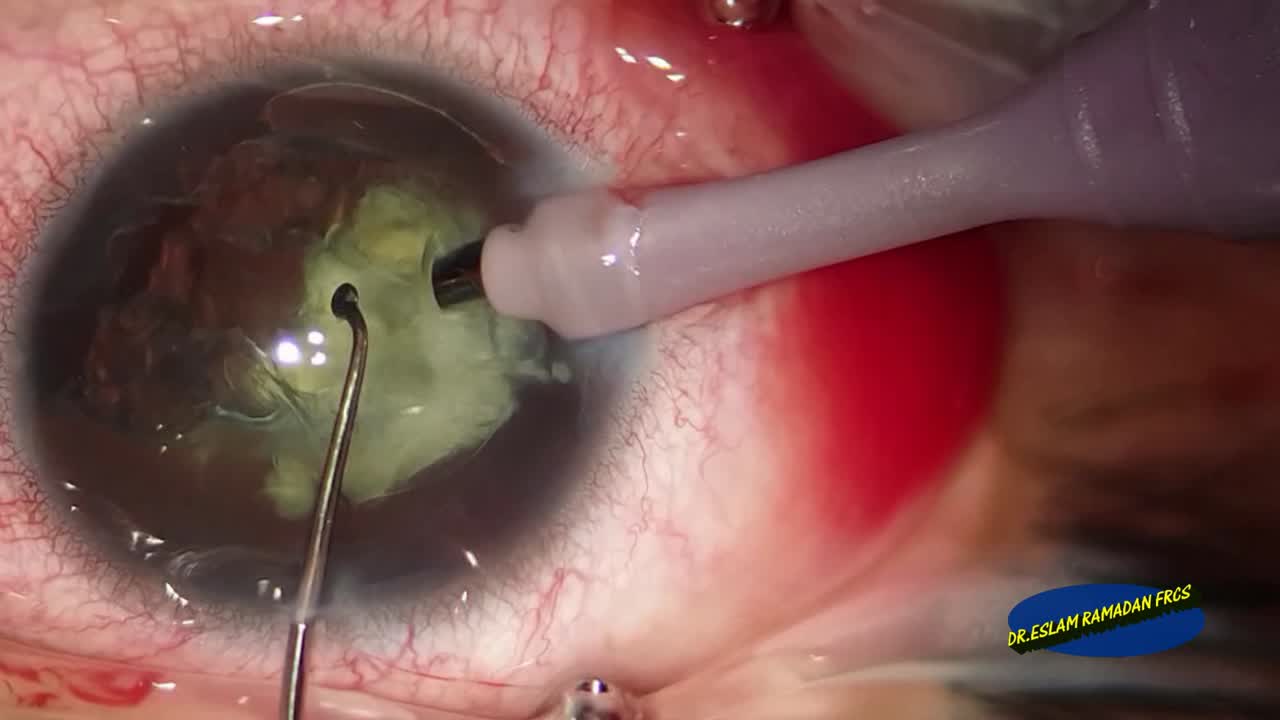 Bimaual Pupilloplasty in Traumatic Cataract and Mydriasis 