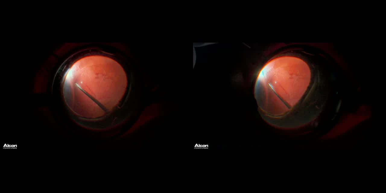 ARN Retinal Detachment With the NGENUITY 3D System