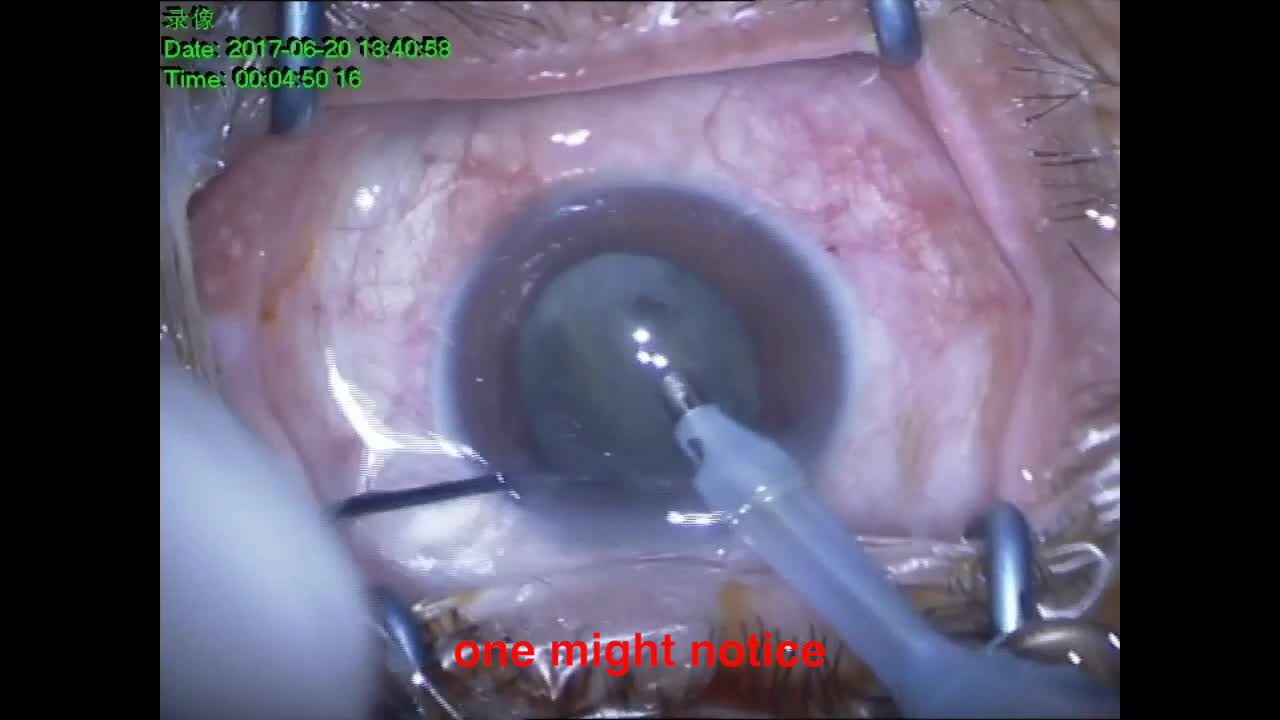 Cystotome-Assisted Prechop Technique