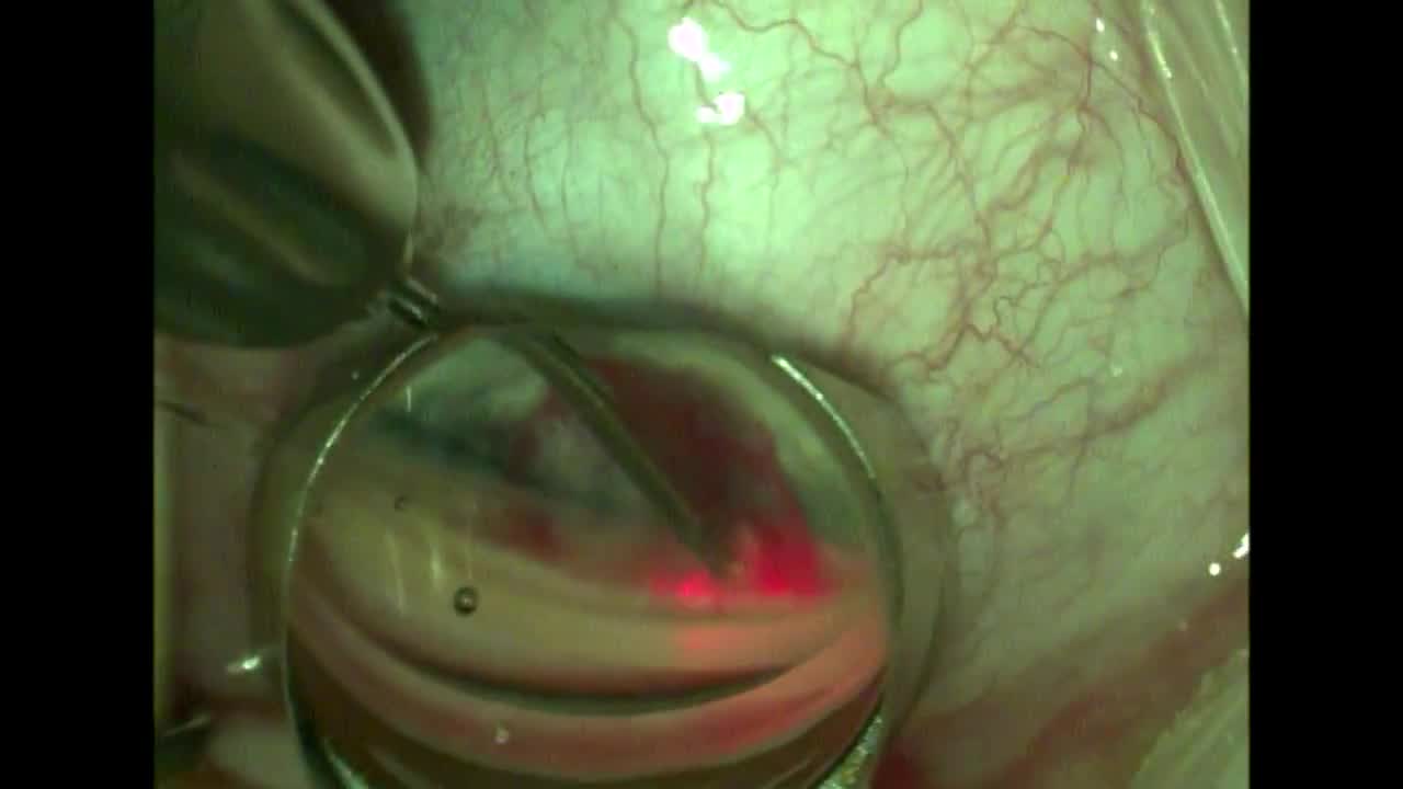 Kahook Goniotomy with Canaloplasty