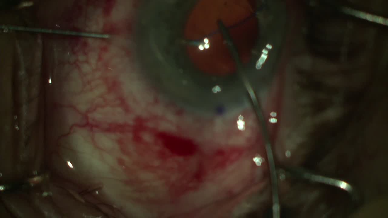 Ahmed Segment Fixation With 5-0 Prolene Sutures