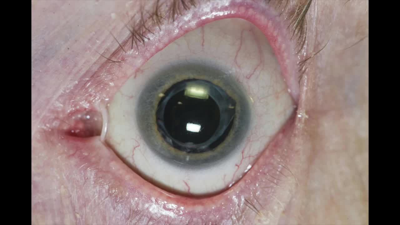 Surgical Repair of Atonic Pupil with Iris Cerclage and Knot Internalization