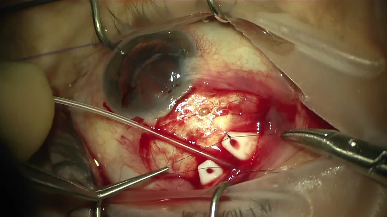 Ahmed ClearPath 250 Surgical Technique