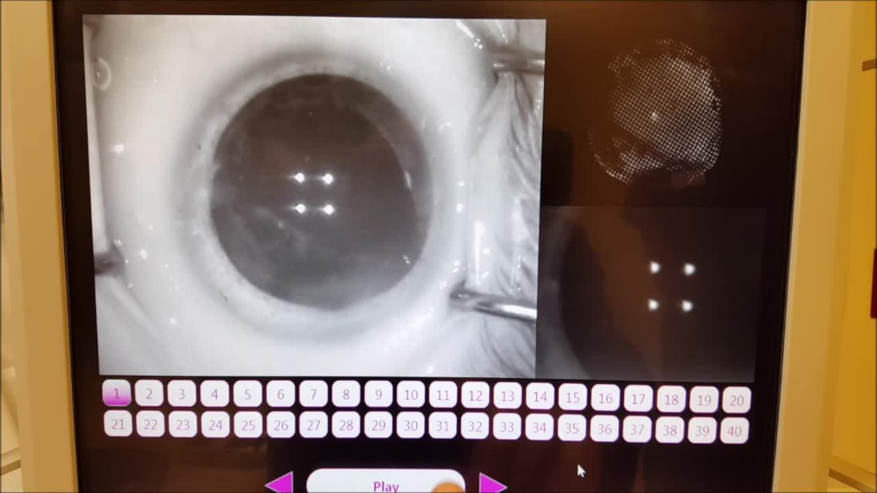 One Way to Deal with Vitreous Opacities When Using ORA