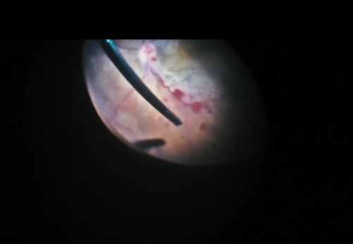 En Bloc Double Peel of Epiretinal Fibrovascular Membrane and ILM