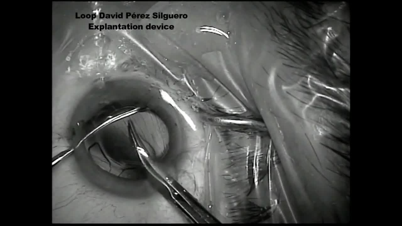 Explantation IOL Loop