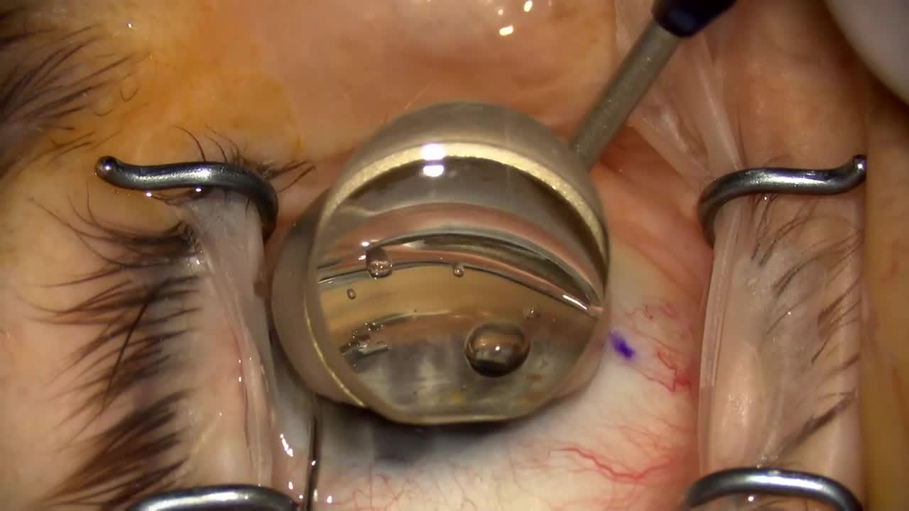 Step-by-Step Hydrus Implantation Tips