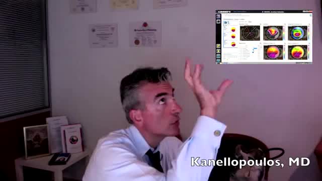 Keratoconus Consultation and Discussion