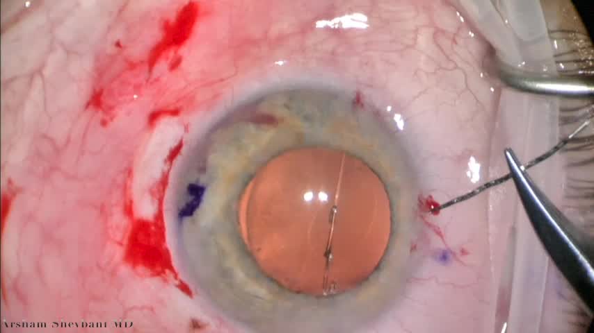 Defying Gravity in Cataract and Glaucoma Surgery