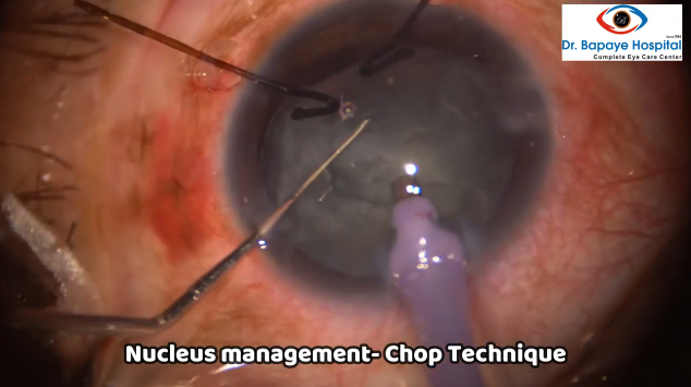 Management of Subluxated Cataract: Hooks, Ring, and Sutures
