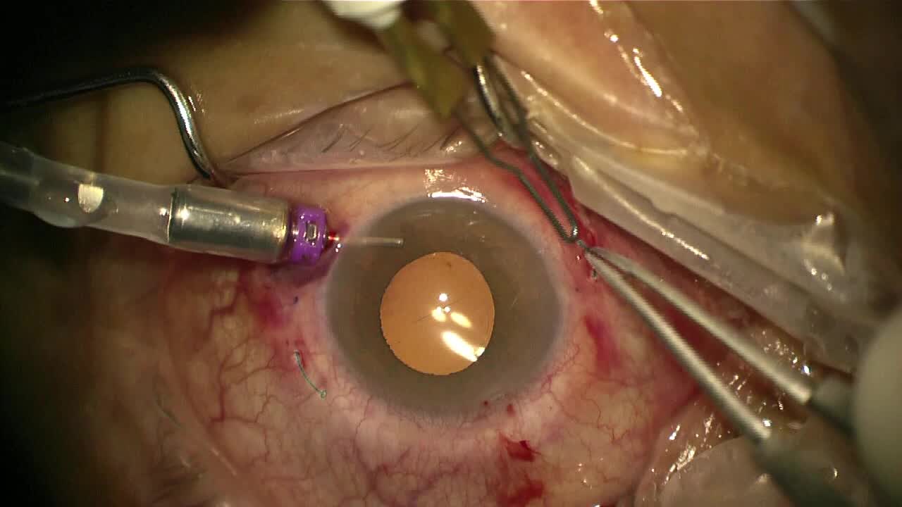 27-Gauge Pars Plicata Vitrectomy and Intrascleral Fixation for Intraocular Lens Dislocation