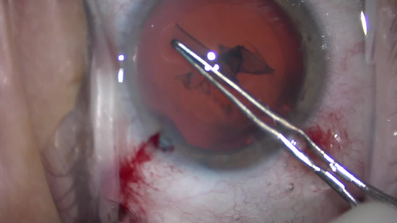 Routine Phacoemulsfication