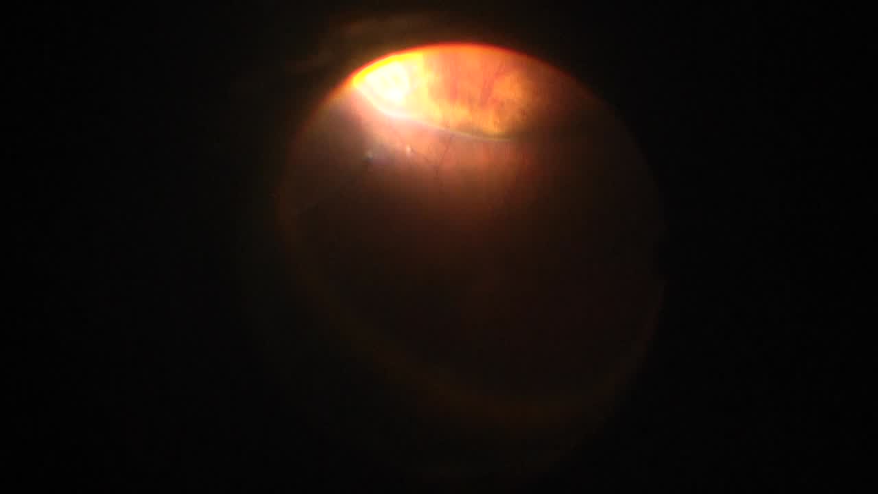 Endolaser-Assisted Scleral Buckle