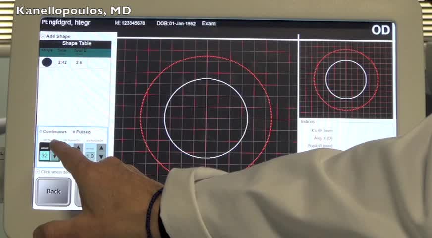 Epithelial On Cross Linking With Variable Fluence Pattern