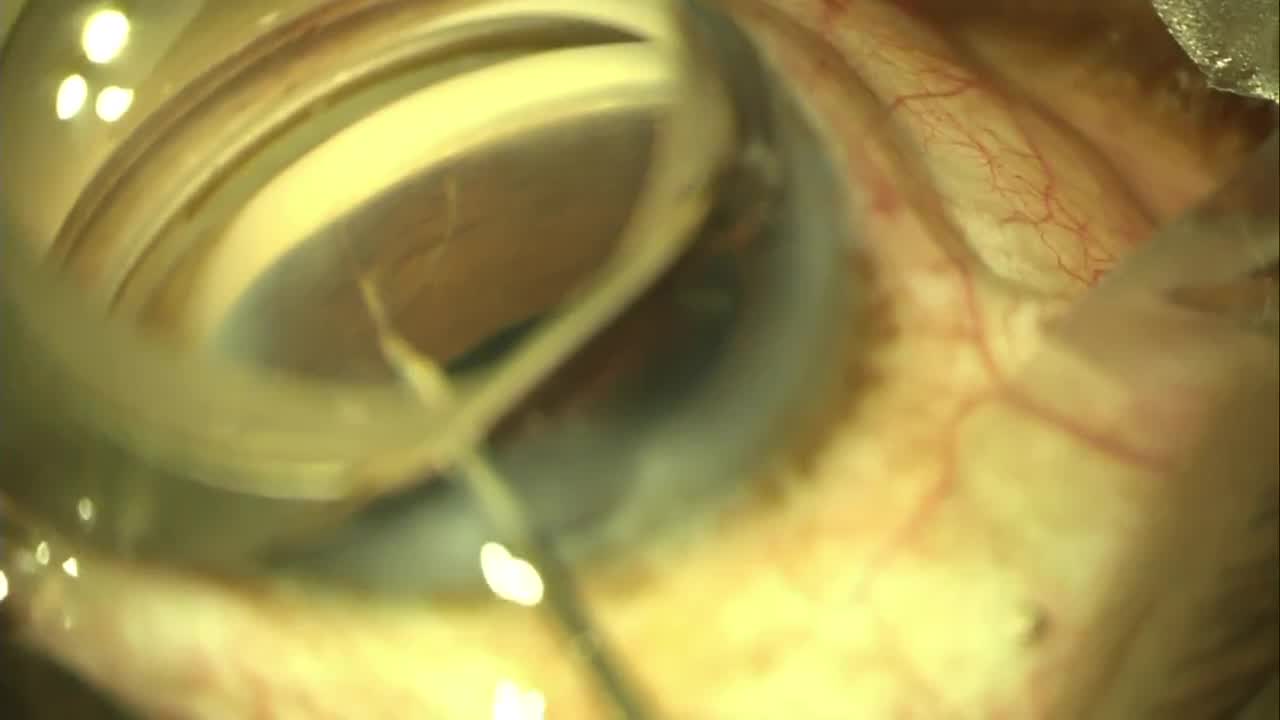 Goniotomy with KDB Eyetube