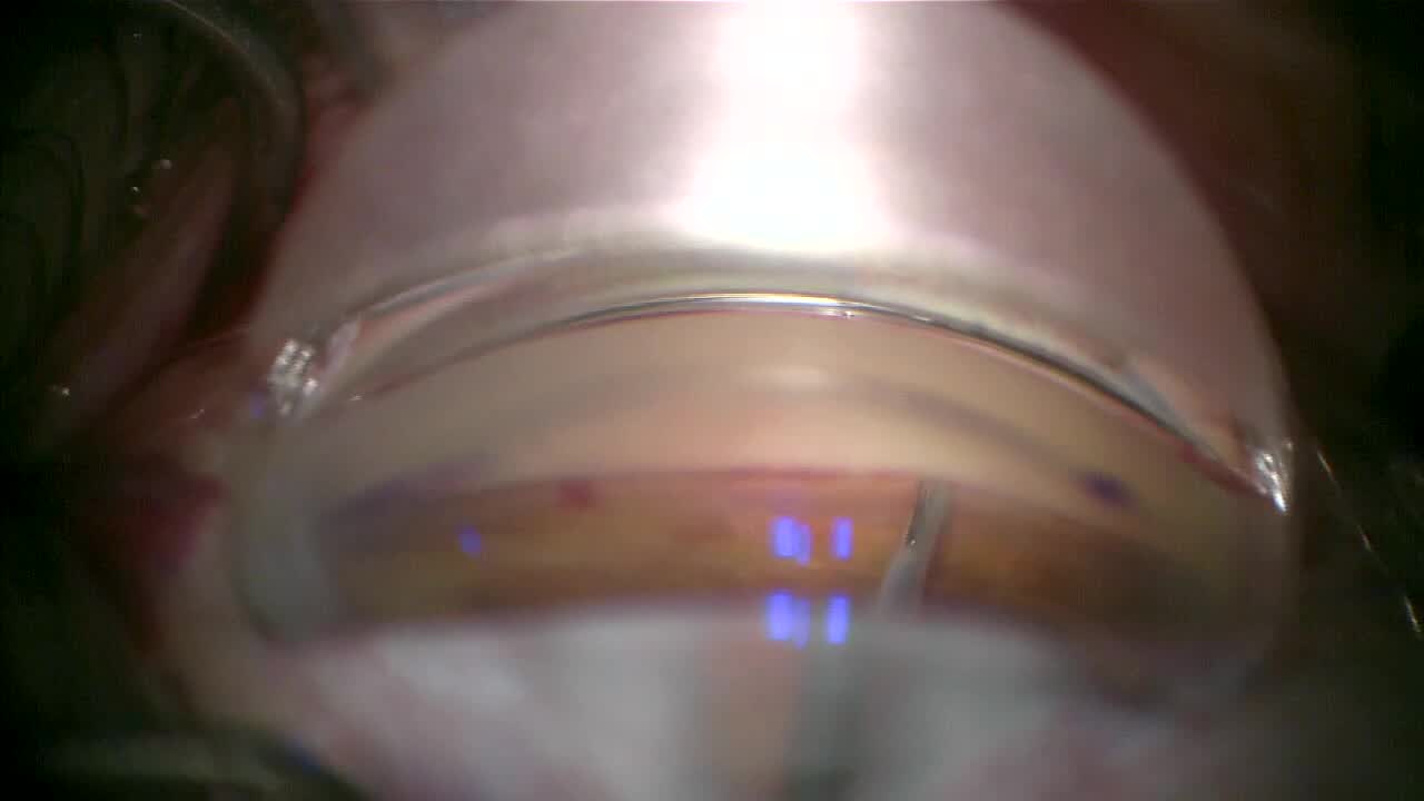 iStent Inject With Premium IOL Implantation