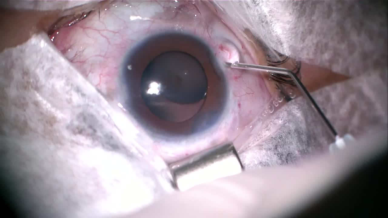Cataract Surgery With Endoscopic Cyclophotocoagulation and IOL Scleral Fixation With Anterior Hyaloid Preservation