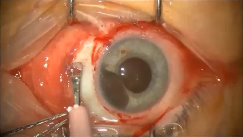 Iridocyclectomy
