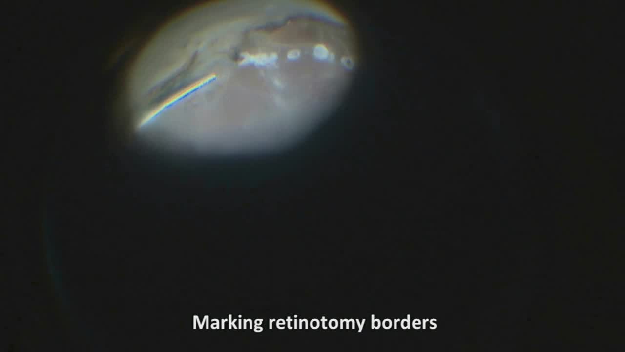Relaxing Retinotomy in Severely Contracted Retina