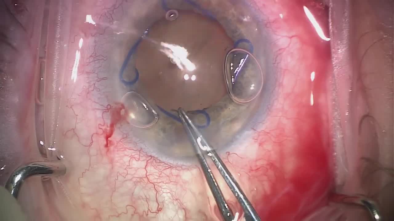 Phacoemulsification and ABiC in a Case of Angle-Closure Glaucoma