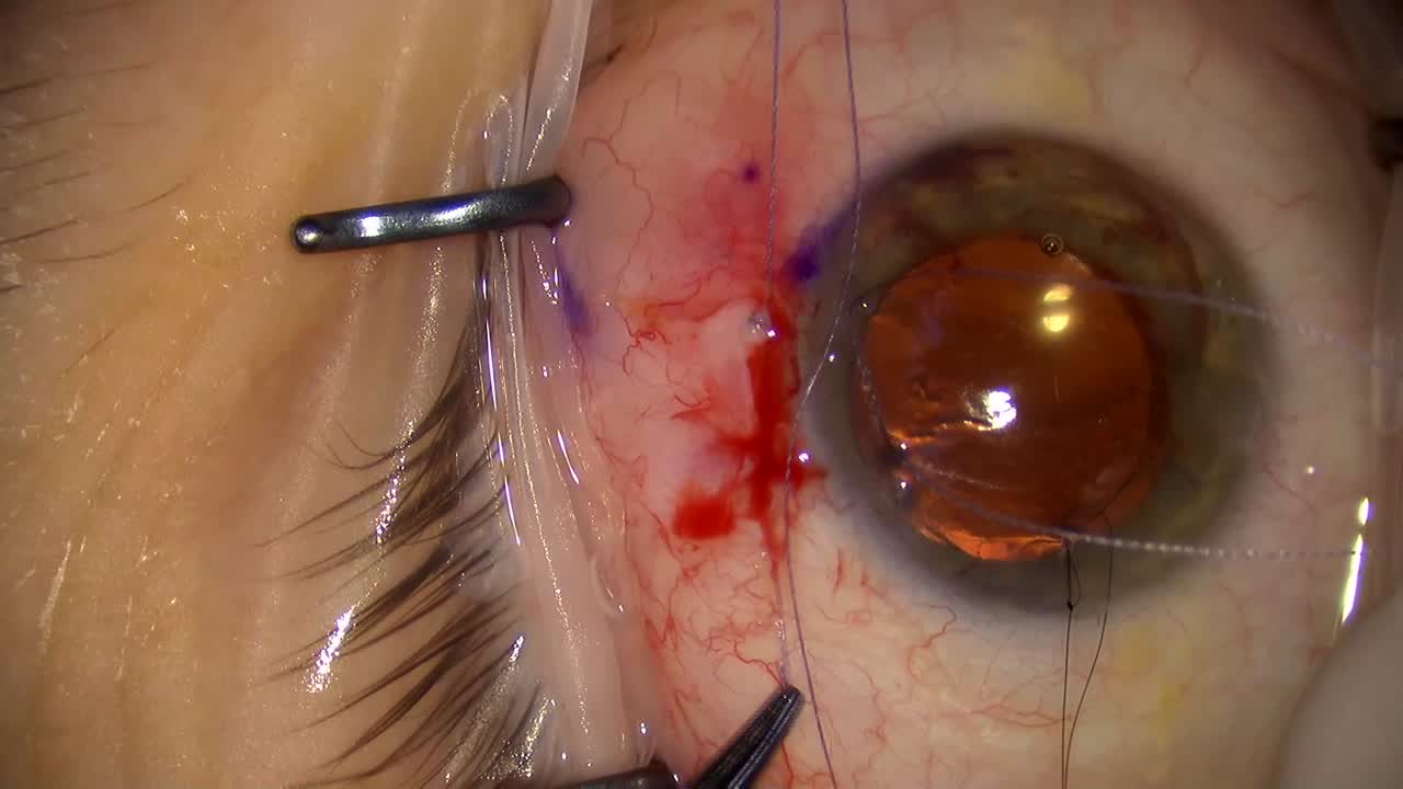 Xen45: Creative Placement