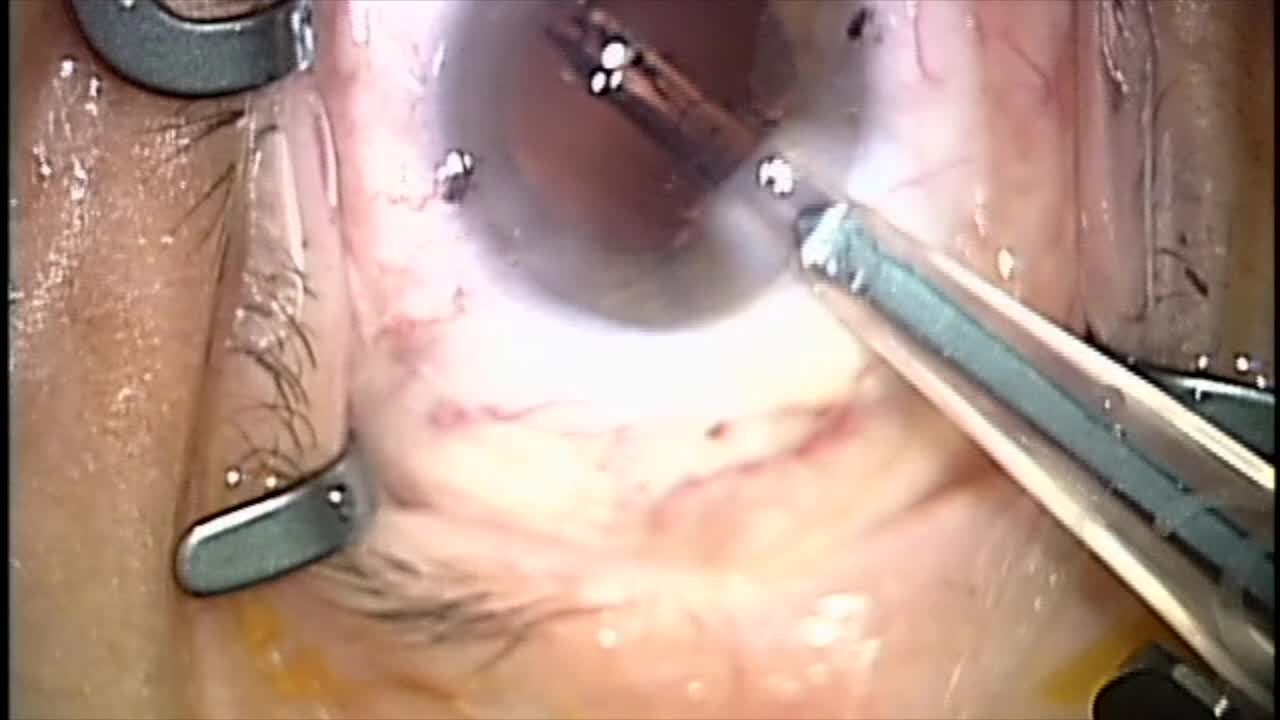 How to Align a Toric IOL Using Bimanual Irrigation and Aspiration