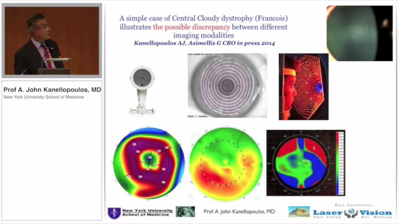 Multifactorial Assessment for Early Diagnosis Keratoconus