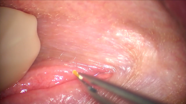 Dextenza Insertion Technique