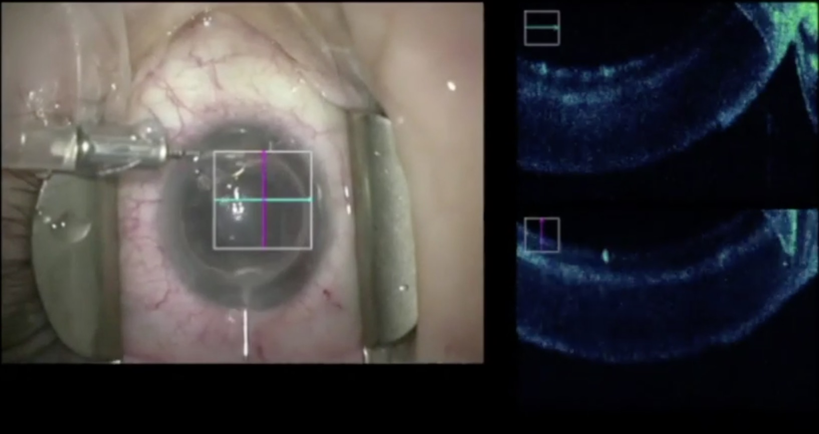 DSAEK after PK with Pull Through Technique - OACS -OCT Assisted Corneal Surgery Nathaniel Mauger 