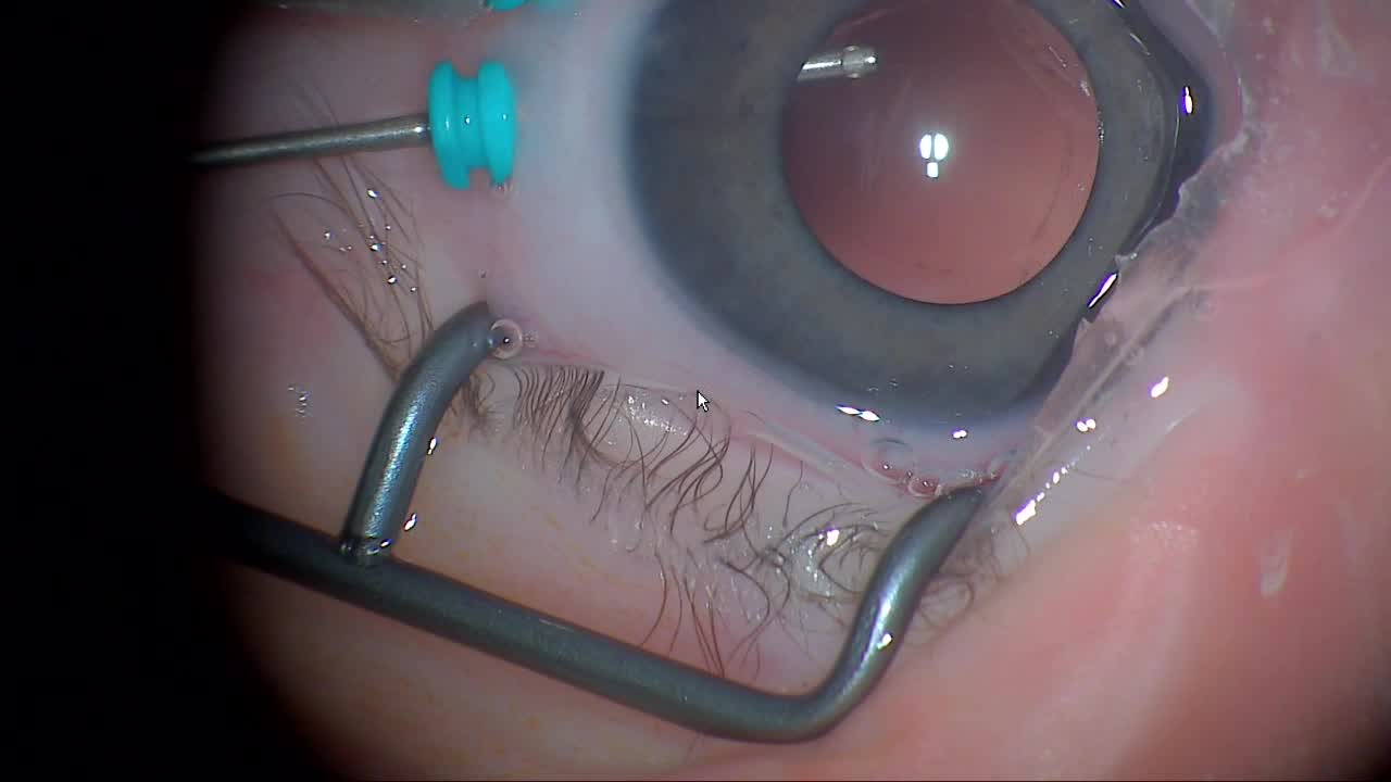 Two-Port 25G Vitrectomy/Lensectomy for the Treatment of Congenital Cataract