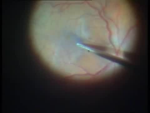 Vitrectomy with a Cataract Machine