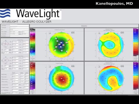 Implantation of a Toric Trifocal