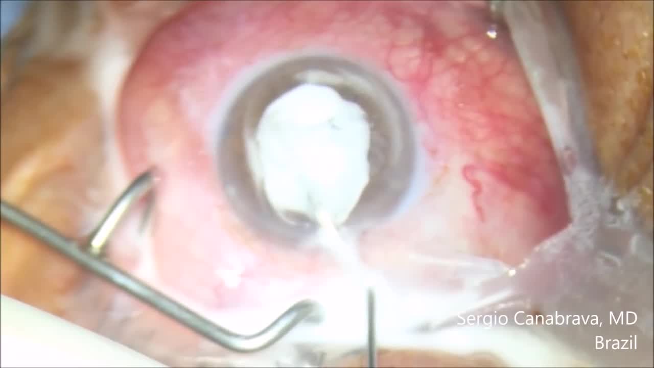 Anterior Vitrectomy Steps